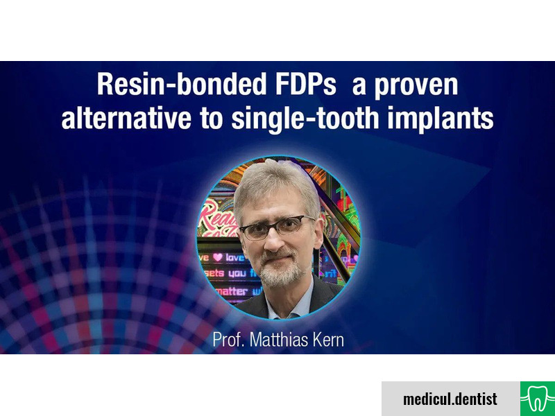 Resin-bonded FDP’s – a proven alternative to single-tooth implants (Webinar, On-demand)
