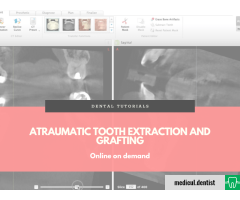 Extractia dentara atraumatica cu aditie osoasa - partea 1 (Online la cerere)